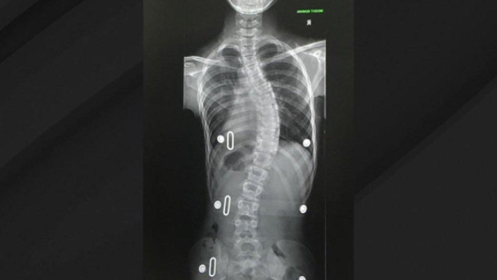 X-ray of Florence Seager's spine