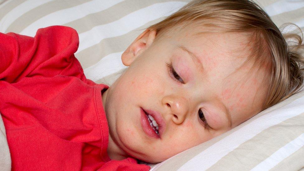 A young boy lies in a bed as he recovers from scarlet fever