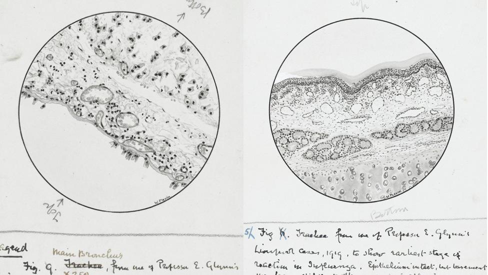 Anatomical drawings of the effect of influenza, from 1918