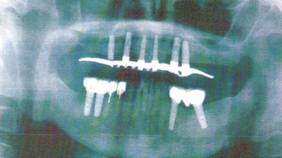 X-ray showing the dental work required by Mr Worthington