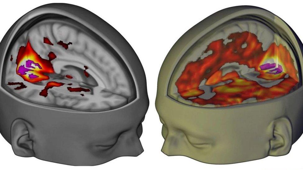 Brain scans