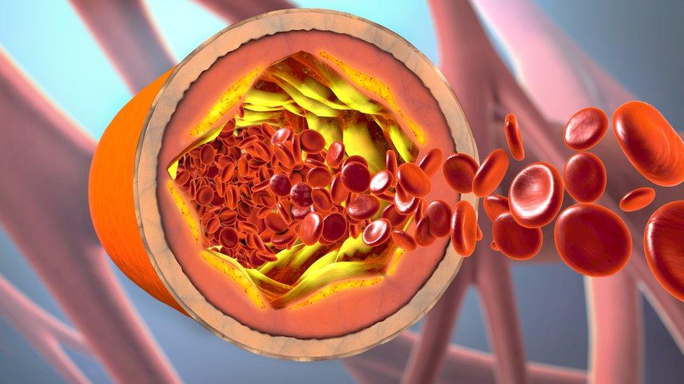 Graphic of a clogged artery