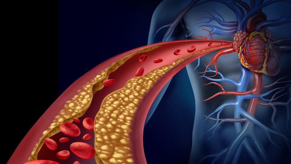 Atherosclerosis