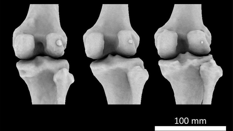 The fabella is a bit like a tiny kneecap