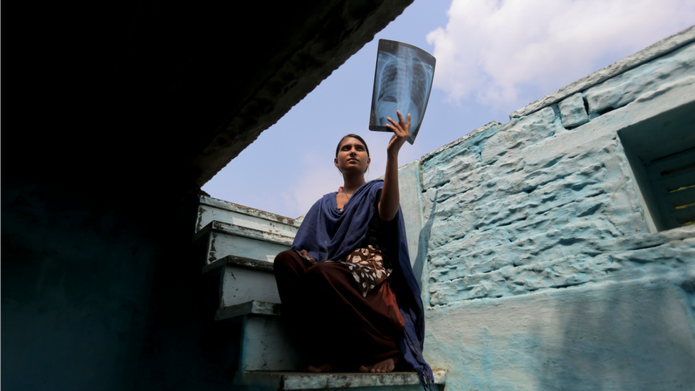 Urmila Yadav with an X-ray of her lungs