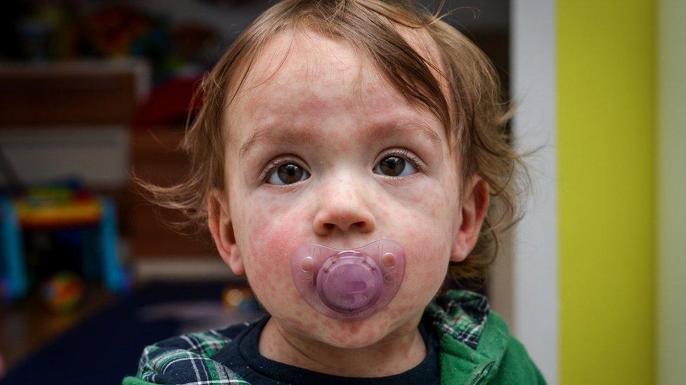 Child with measles