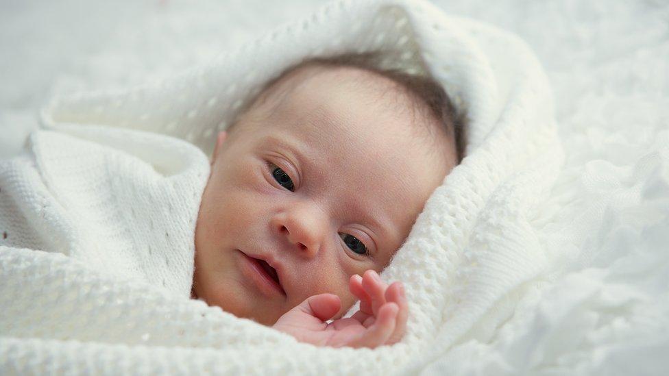 A baby with Down's syndrome