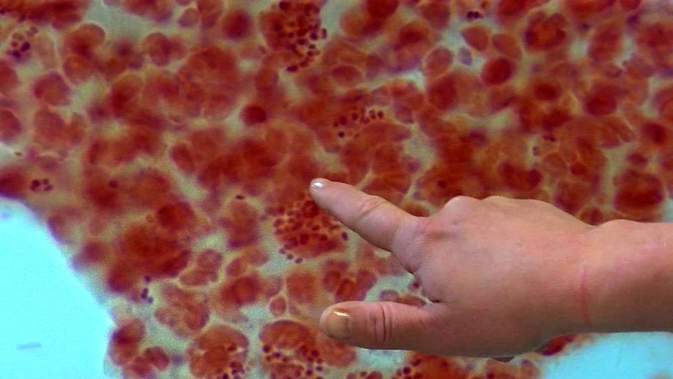 Finger pointing to microscopic picture of gonorrhoea