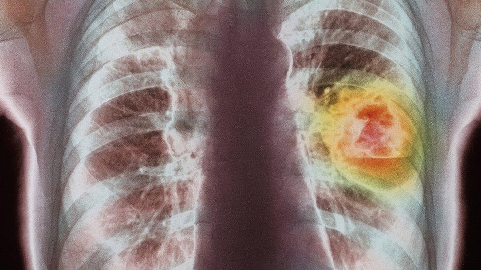 An x-ray of lung cancer