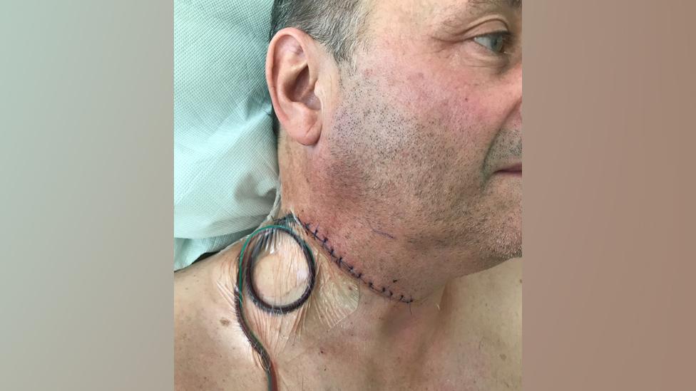 Mark Radcliffe's scar after surgery