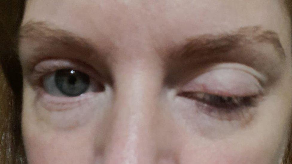 Amy's closed eye following Botox injection