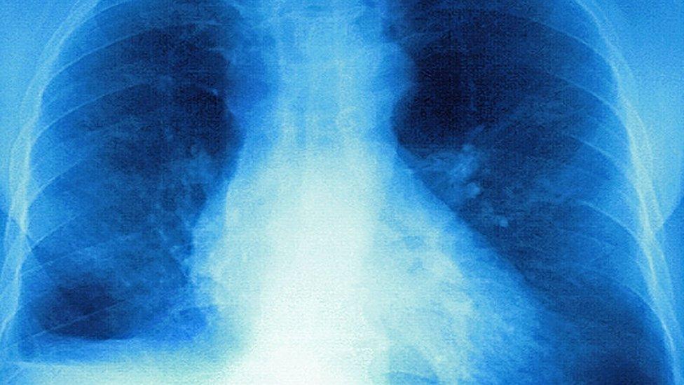 Lungs affected by cystic fibrosis