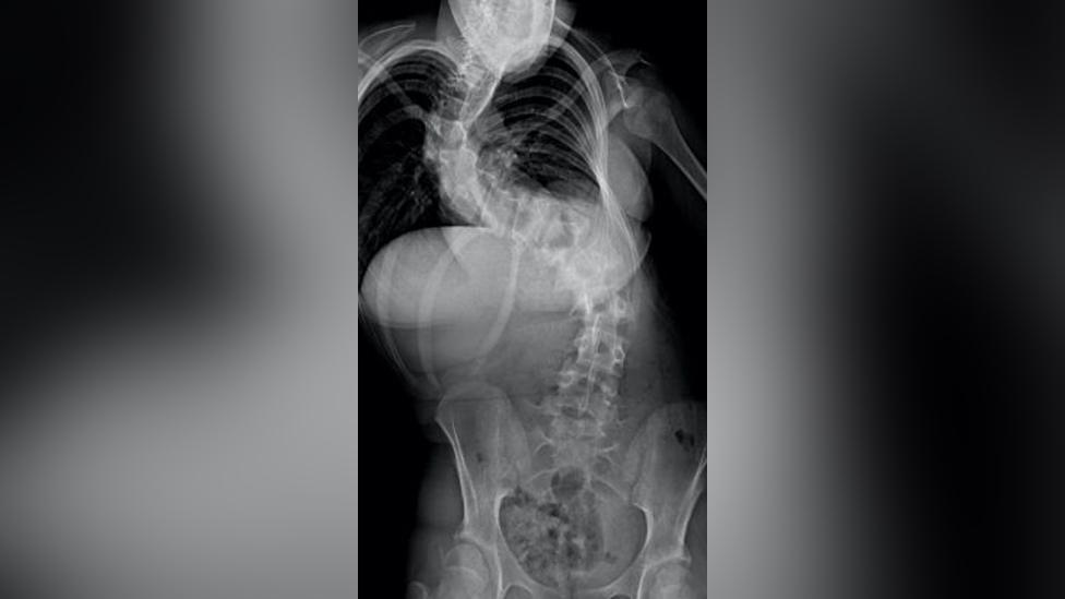 X-ray of person with scoliosis