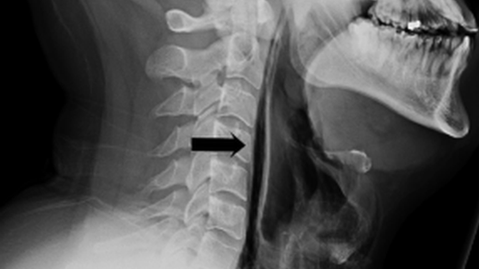 x-ray of the man's neck