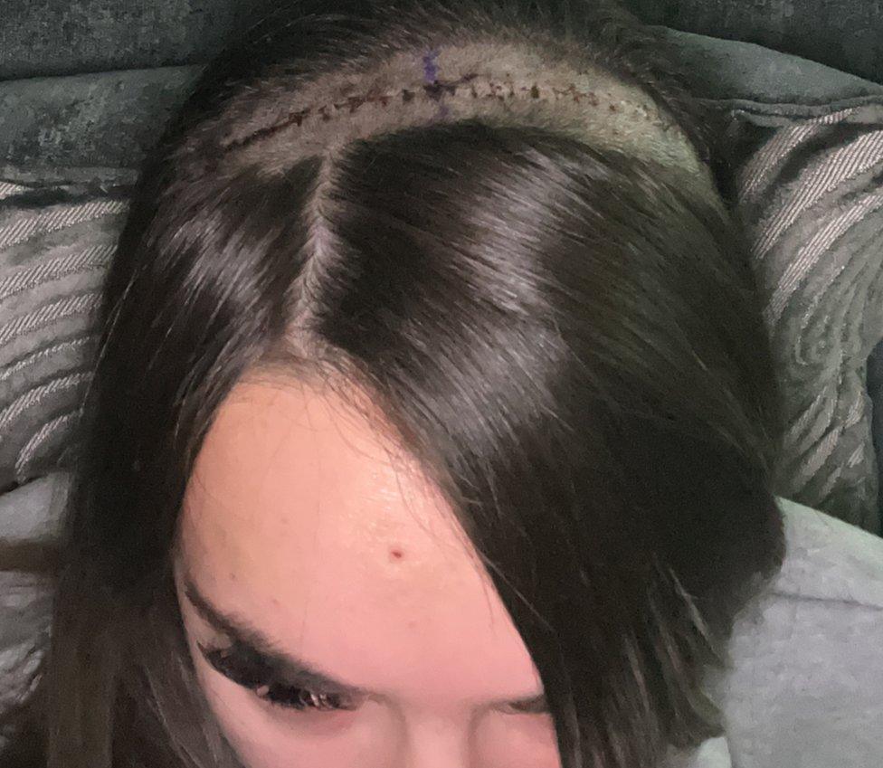 scar on Paige's head