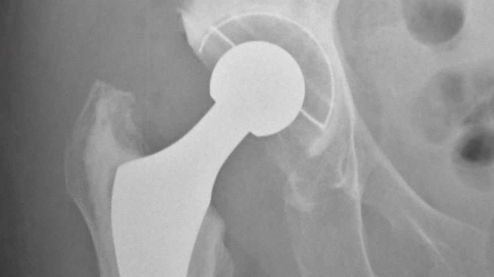 X-ray of a hip replacement