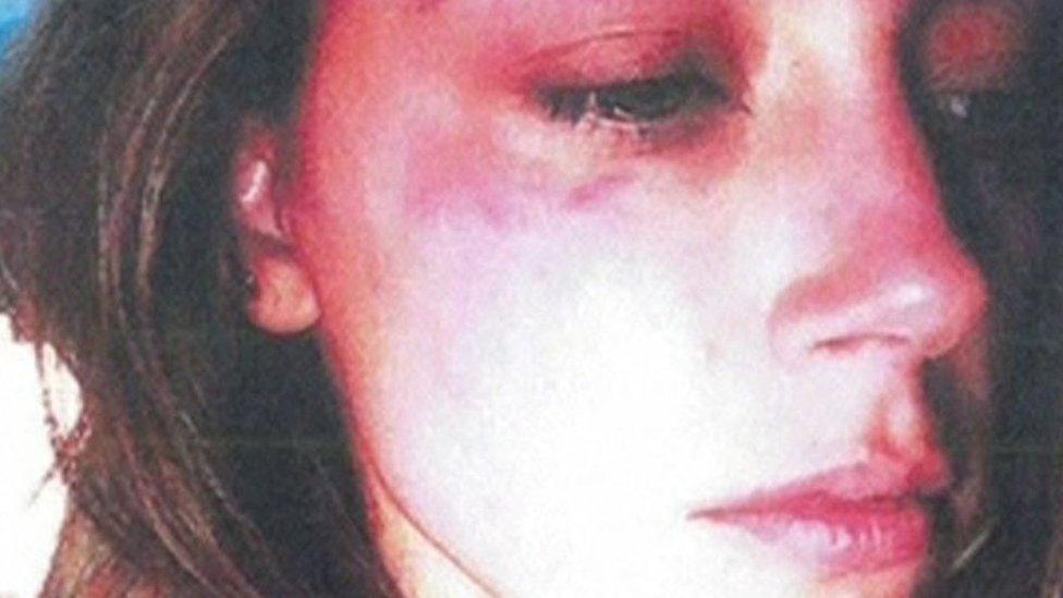 Amber Heard, shown in a photo with a bruised face