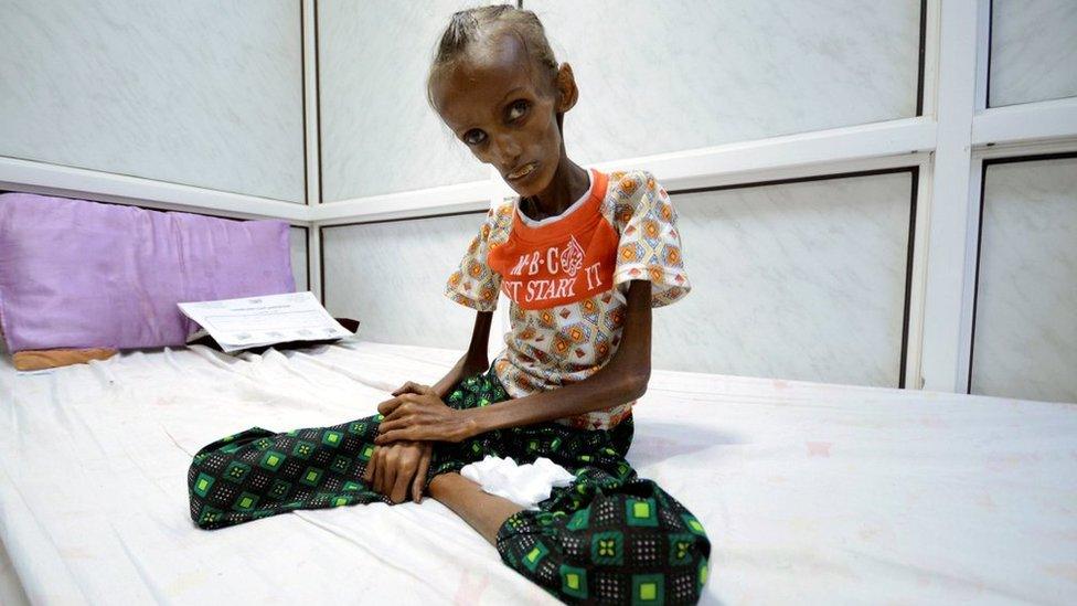 Eighteen-year-old Saida Ahmad Baghili sits on a hospital bed in the red sea port city of Hudaydah (25 October 2016)