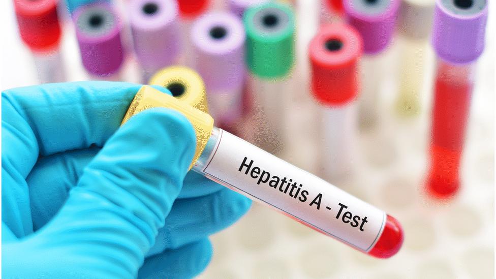 A Hepatitis A test shown in a laboratory