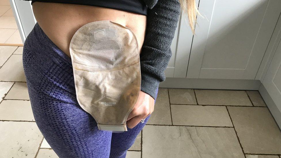 Beth Hewitt's stoma bag