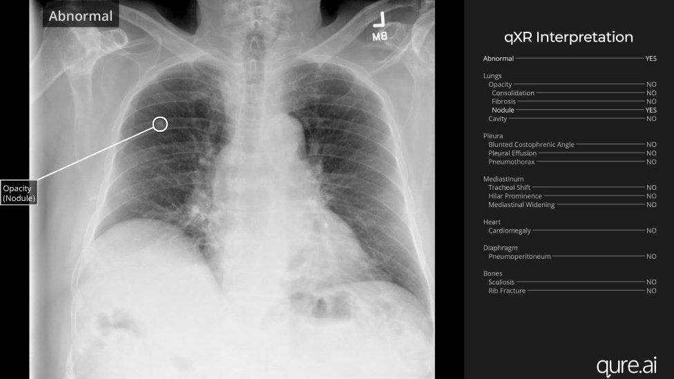 Chest x-ray