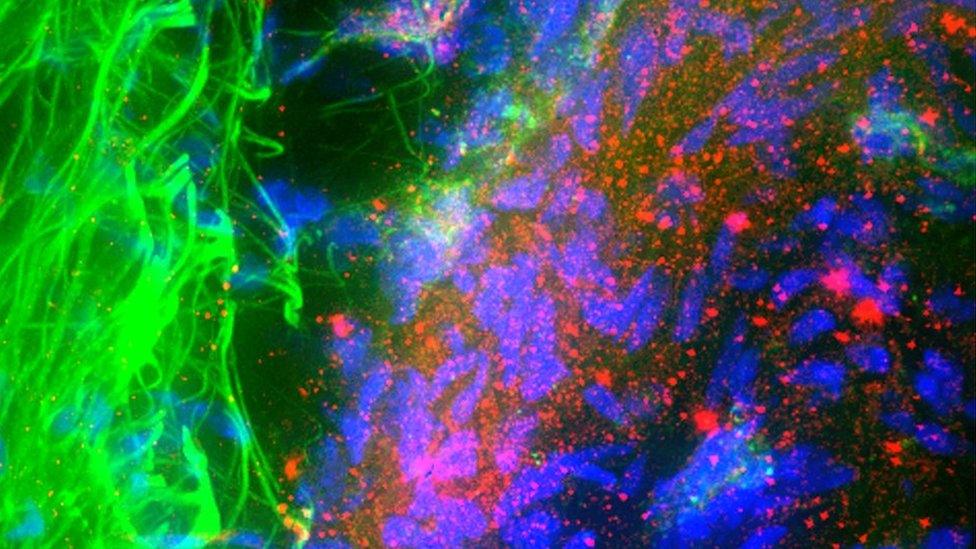 The accumulation of the protein alpha-synuclein (shown in red) is thought to cause the progressive degeneration of the neurons that leads to the symptoms of Parkinson's disease