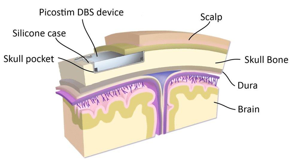 A diagram of the layers of the skull and where the battery fits