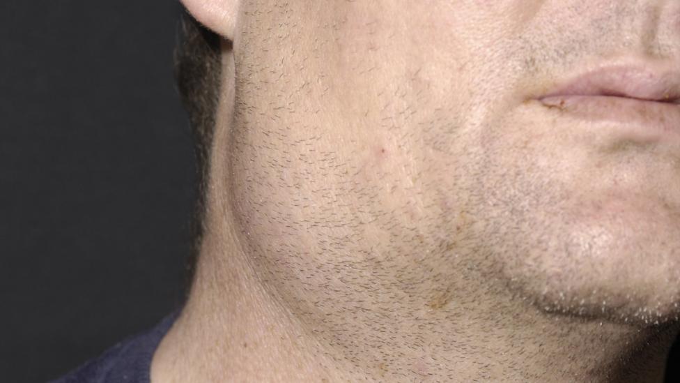 Mumps: Why adults might still need the MMR jab - BBC News