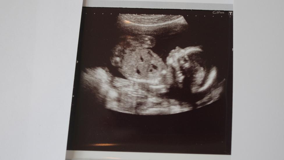 A scan of Corrie Mckeague's baby