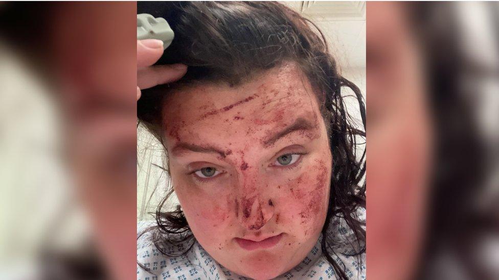 Georgia Wood suffered a bleed on the brain