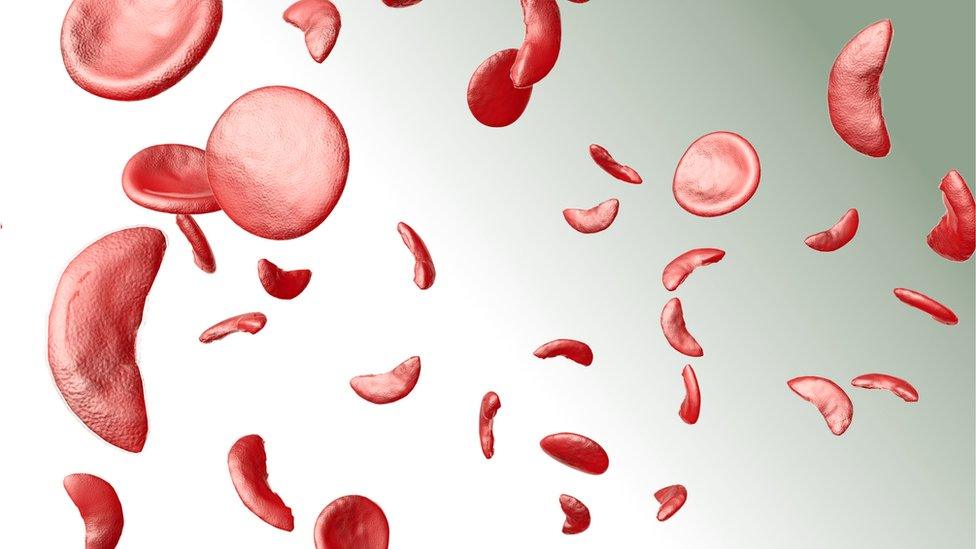 3D illustration of sickle cells