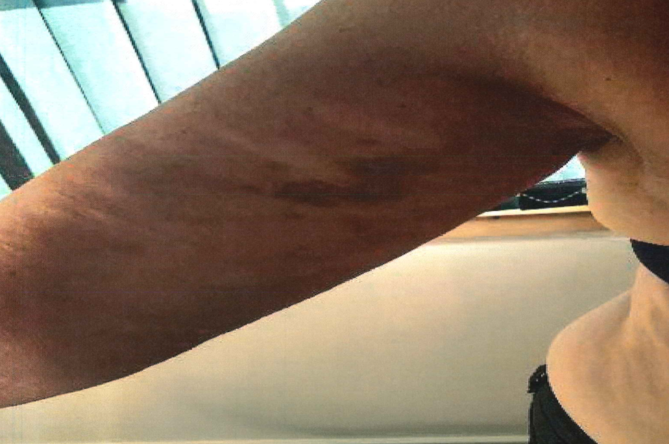 Carolyn arm bruises