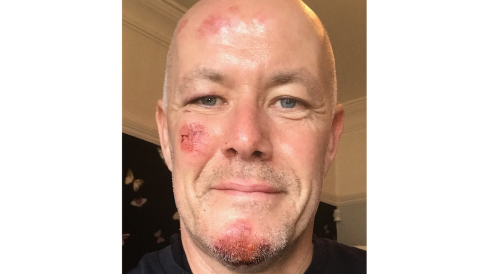 Cyclist Phil Williams with facial injuries after the hit and run