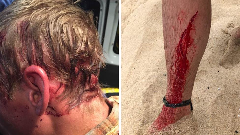 A composite image of Dylan McWilliam's head wound from a beat attack and leg injury from a shark bite