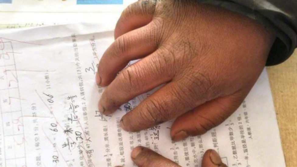 Swollen hands of a migrant child