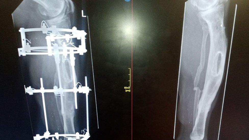 An x-ray of Graham Parker's leg after it was fitted with a steel cage