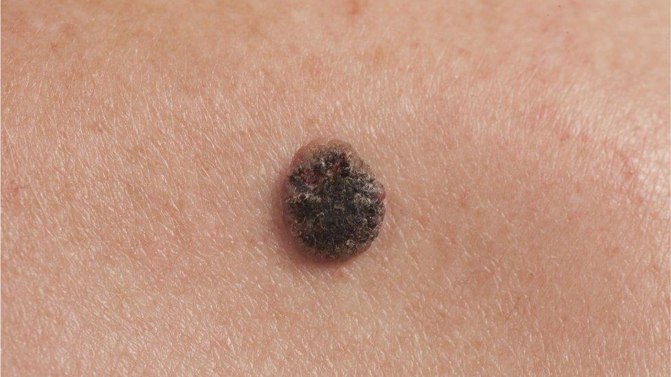 mole on skin