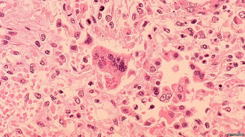 A handout image from the Centers for Disease Control and Prevention of measles viewed through a microscope in 1972