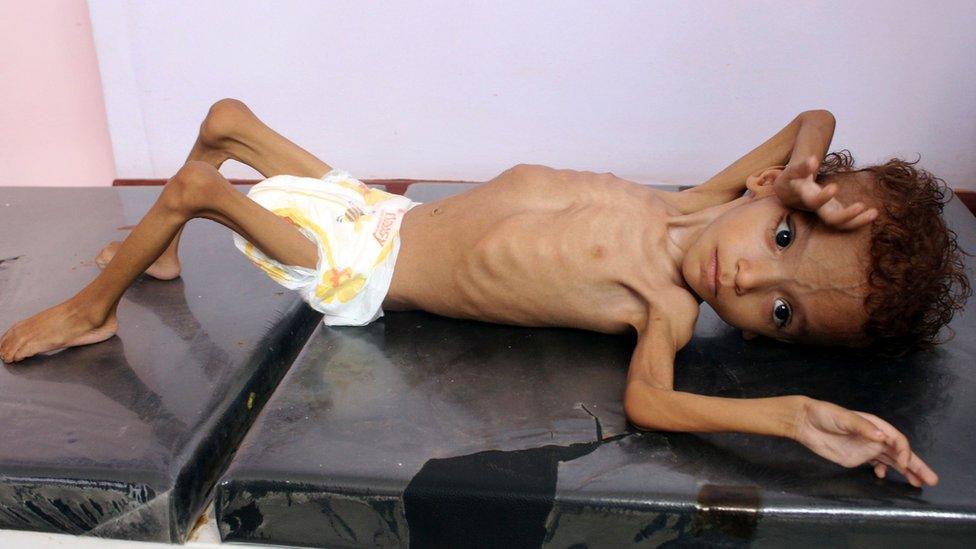 A Yemeni child suffering from malnutrition lies on a bed a hospital in Abs, Hajja province, Yemen (18 August 2018)