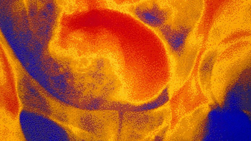 Enlarged prostate on medical scan
