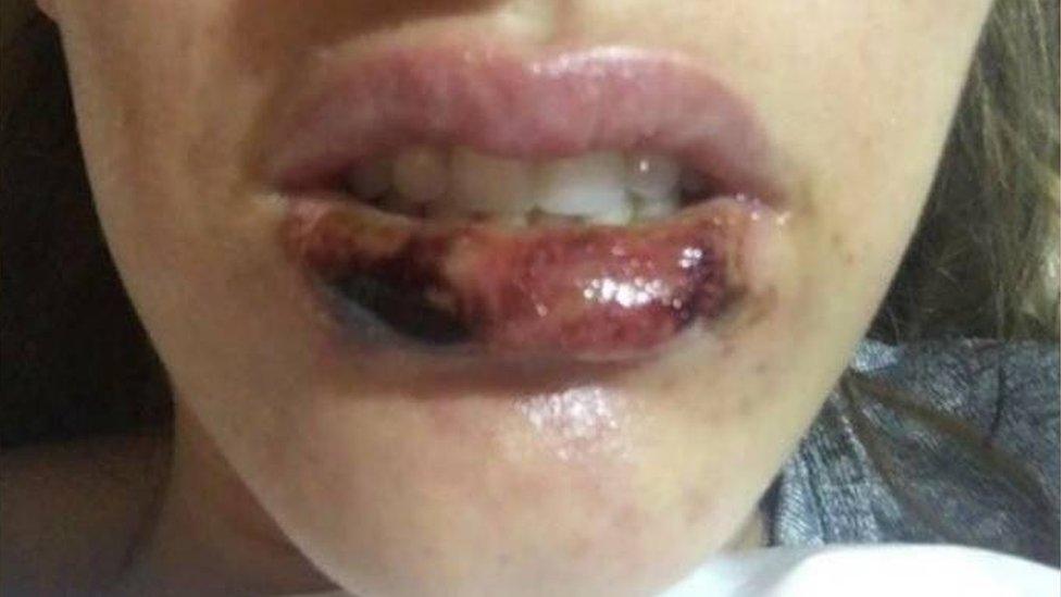 woman with infection in lip after filler