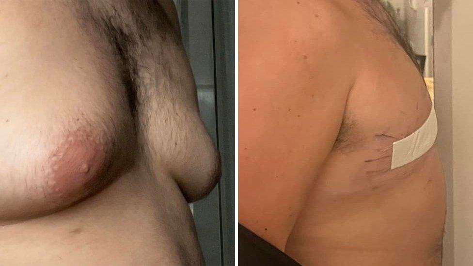 Conor McGinty's chest before and after the surgery