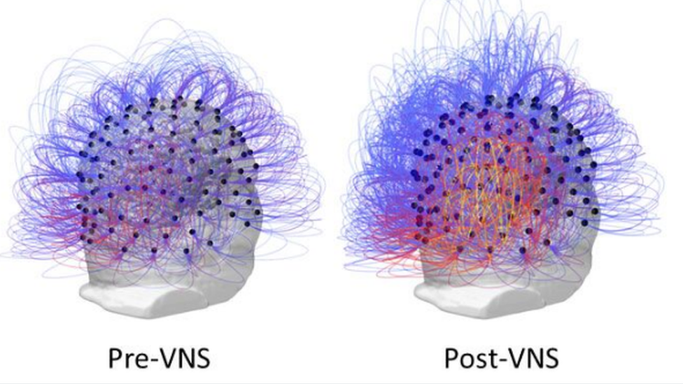 Brain scan