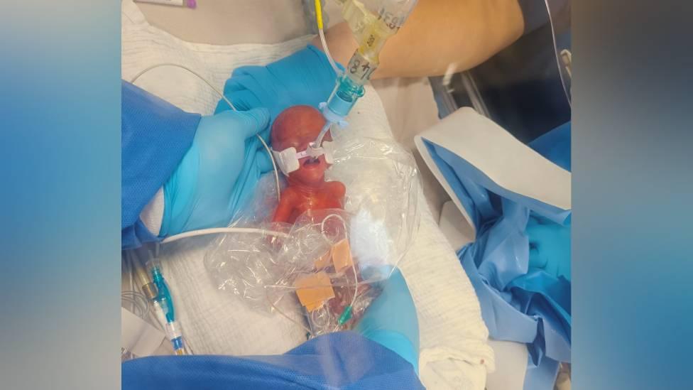 Baby Robyn in a sandwich bag, with nurses caring for her