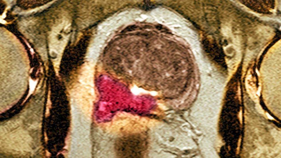 MRI scan of the prostate