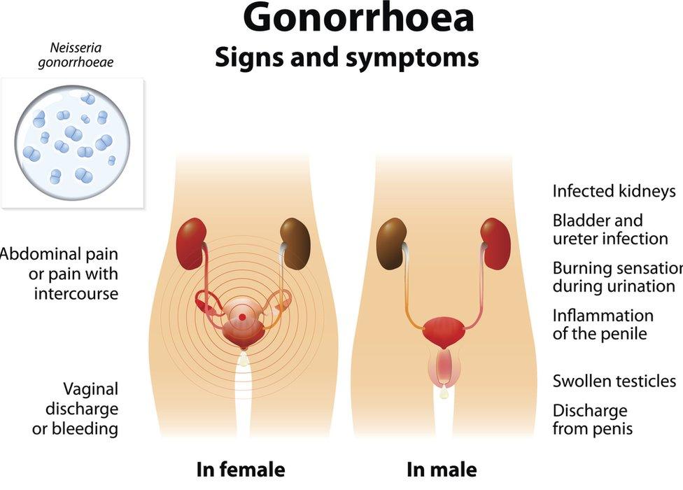 Gonorrhoea graphic