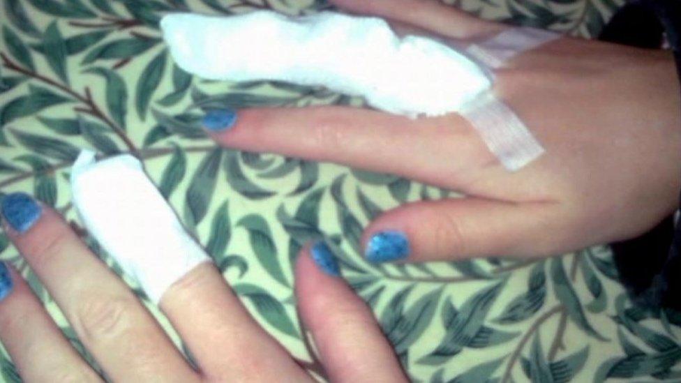 Images of Stephanie's hands after the accident