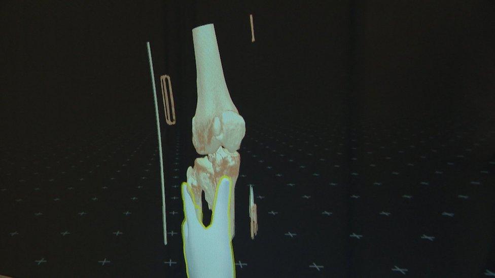 scan view of bone break