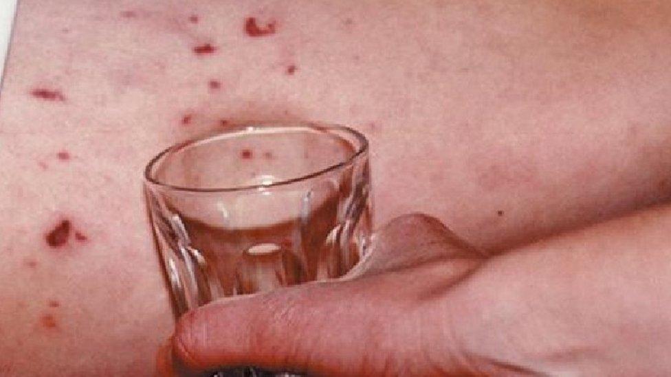 Meningitis rash advert