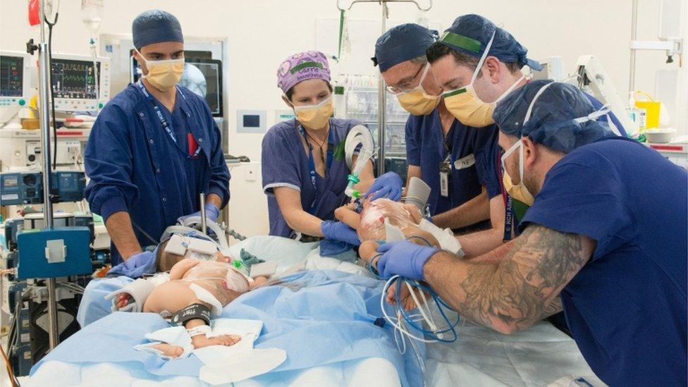 Surgeons remove one of the babies